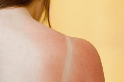 sunburn tips toronto dermatologists