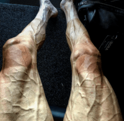 leg vein treatment toronto