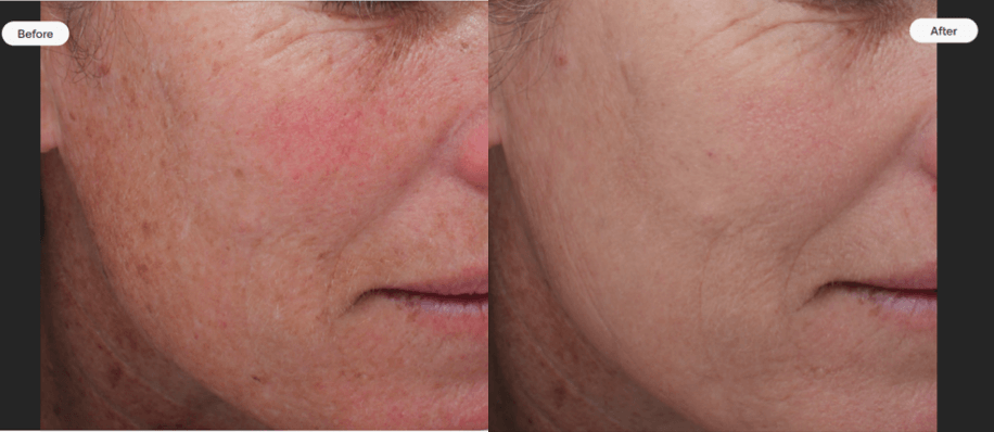 before and after moxi laser